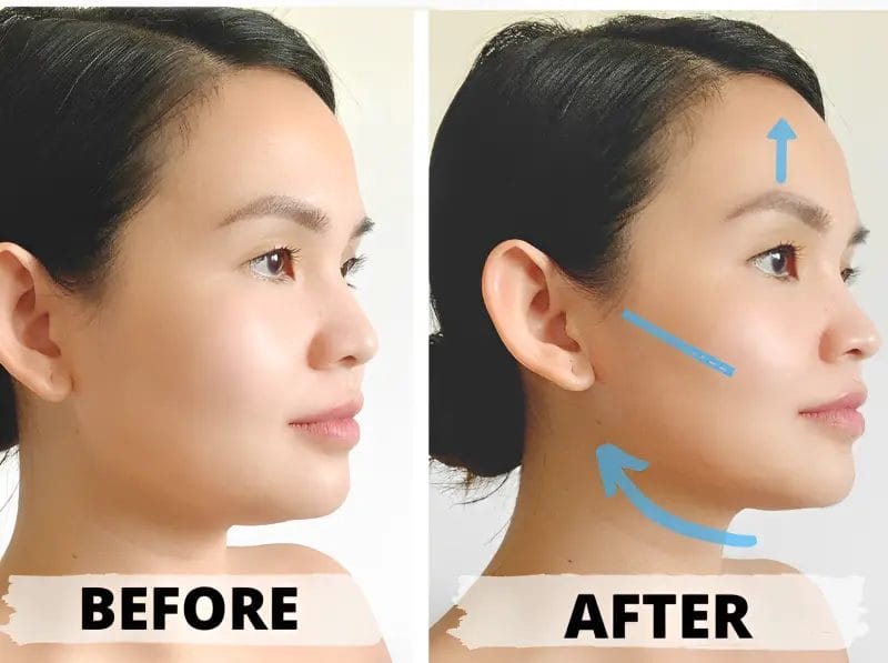 gua sha for double chin before and after